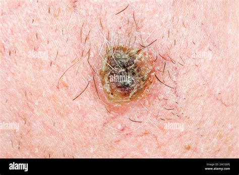 Close Up Of Basal Cell Carcinoma On The Cheek Of An Adult Male Patient