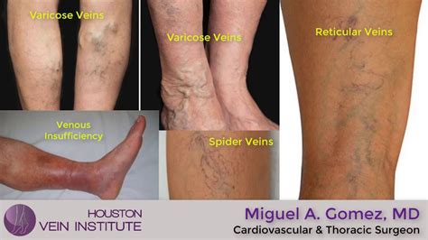 Houston Vein Institute Dr Miguel A Gomez Youtube