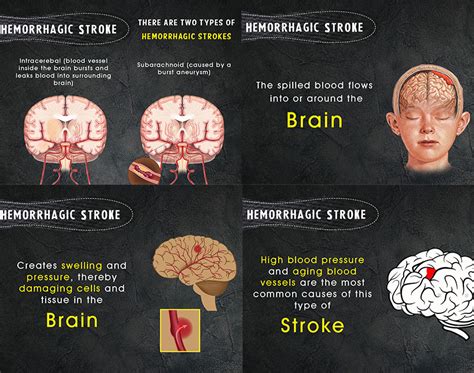 • institutional factors include the availability of endovascular services and the volume of sah patients treated. Types of Strokes | Kauvery Hospital