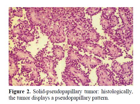 Solid Papillary Tumors Of The Pancreas Histopathology