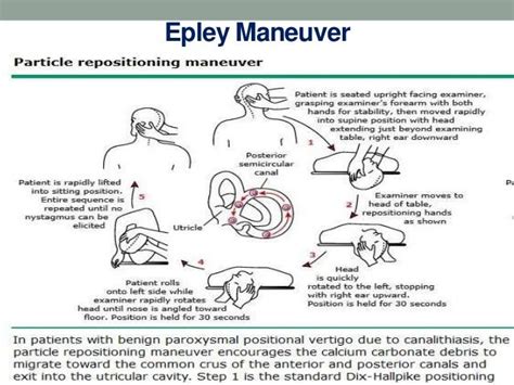 Epley Maneuver Left Side Pdf