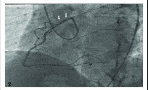 Selective Cannulation Of The Right Coronary Artery Revealed Right