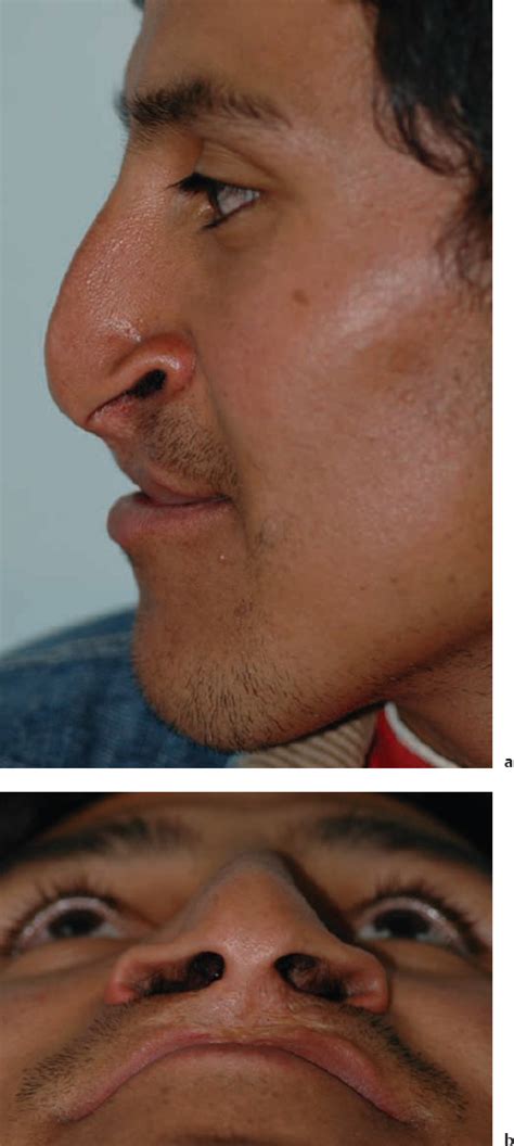 5 Cleft Lip Repair Bilateral Plastic Surgery Key