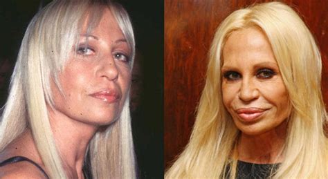 famosos antes y después de la cirugía Chic
