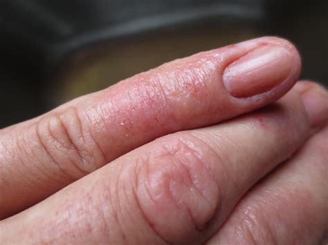 Eczema On One Finger Dorothee Padraig South West Skin Health Care