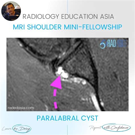 Paralabral Cyst Shoulder Labrum Mri Radedasia