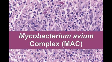 Mycobacterium Avium Complex Mac Youtube