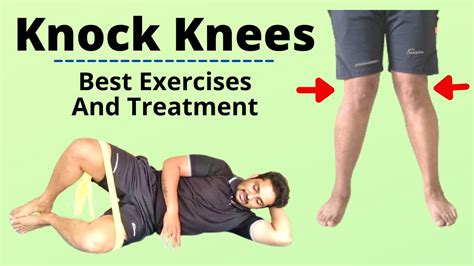 Knock Knees Treatment Knock Knees Correction Exercises Genu Valgum
