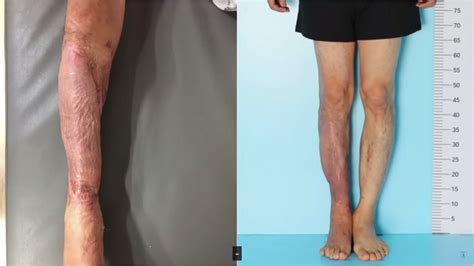 事故で切断の危機だった脚を護って、26cmの延長で治療 Dr Donghoonのブログ