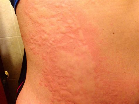 Hives Urticaria Skin Rash With Red Raised Itchy Bumps Skin My Xxx Hot Girl