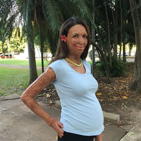 Pregnant Burns Survivor Turia Pitt Shows Off Baby Bump Now To Love Burn Survivor Women