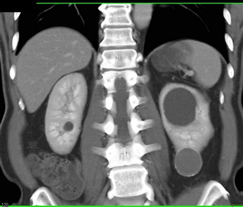 Bosniak 2f Cyst Lower Pole Left Kidney Kidney Case