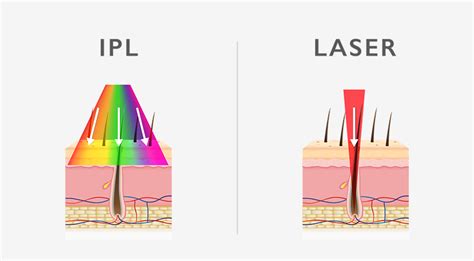 Ipl Vs Laser Hair Removal Which Is Better Thespaclinic Harrogate
