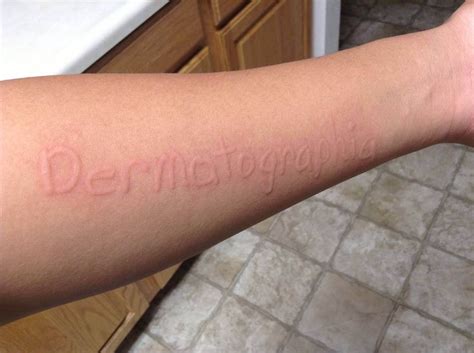 What Is Dermographism And What Causes Dermatographic Urticaria Hives