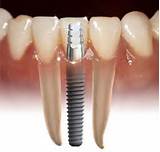 Pictures of Insurance Cover Tooth Implant