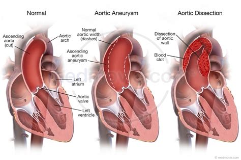 Image Gallery Dissection Aortic