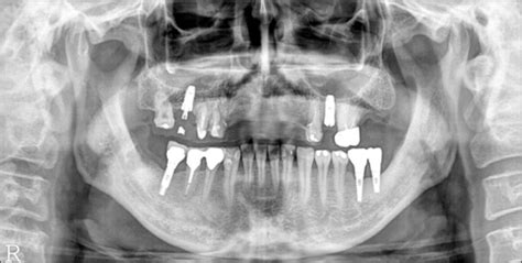 A Panorama Radiograph Taken 5 Months After Bone Graft Open I