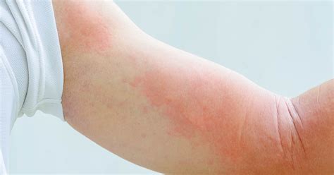 Types Of Eczema Seven Types Of Eczema To Be Aware Of