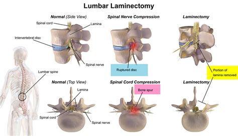 Laminectomy Surgery Recovery Laminectomy Complications