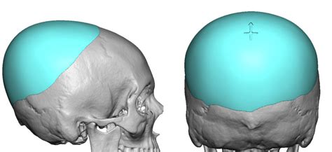 Plastic Surgery Case Study Custom Skull Implant Replacement Of