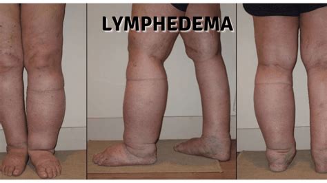 Lymphedema Reddy Care Physical And Occupational Therapy Physical Therapists