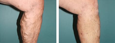 Sclerotherapy Varicose Veins Treatments Scotland The Vein Surgery