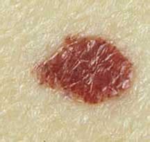 Cherry angiomas are most often found on the trunk of the body but they can appear anywhere, including on the arms, legs, neck, and face. Cherry Angiomas - Englewood, CO | Colorado Skin & Vein