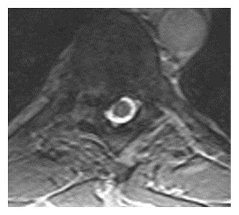 Preoperative Mri Images Of A T8 9 Disc Herniation Compressing The