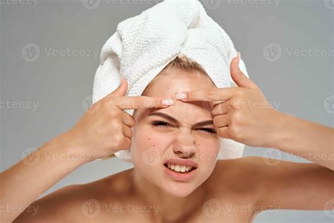 Woman With Bare Shoulders Squeeze Pimples On Her Face Towel On Her Head