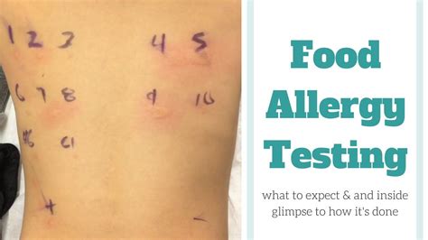 Food Allergy Skin Testing Food Allergies Food Allergies Testing