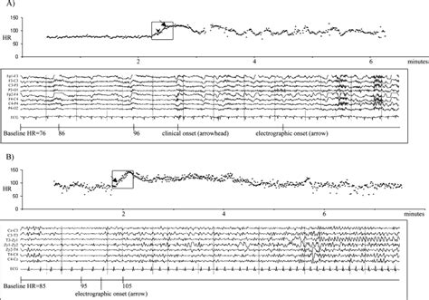 Heart Rate Changes And Ecg Abnormalities During Epileptic Seizures