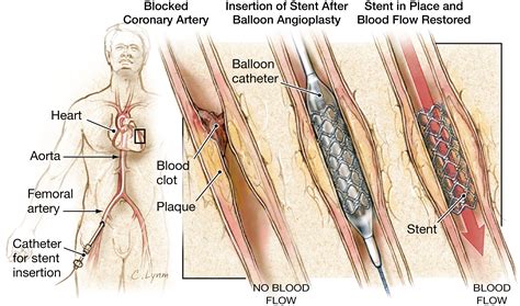 Every year about 785,000 americans have their first heart attack. Stents to Treat Coronary Artery Blockages | Cardiology ...