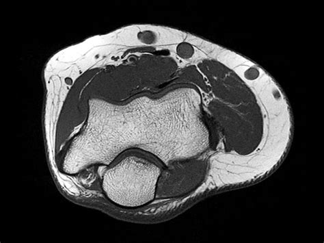 Elbow Imaging Philips Mr Body Map