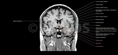 Brain Coronal Section Basal Nuclei And Related Structures Corpus