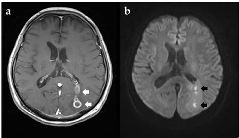Periventricular Lesions Of Brain In Adults A Pictorial Review