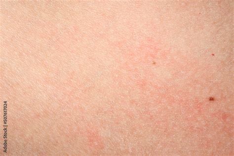 Skin With Acne With Red Spots Health Problem Skin Diseases Close Up