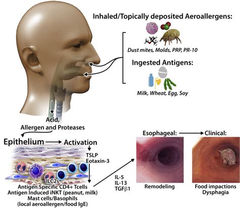 Allergic Components Of Eosinophilic Esophagitis Journal Of Allergy