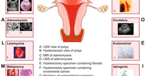 Abnormal Uterine Bleeding In Reproductive Aged Women