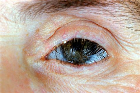 Eyelid Problems Nidirect