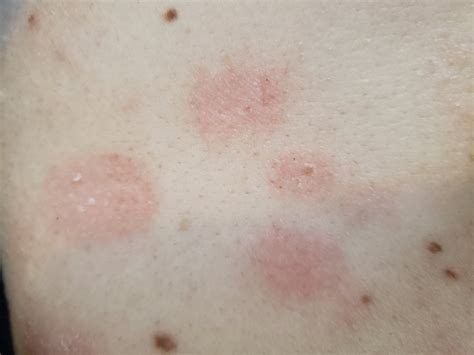 Cannot Figure Out What This Rash Is Dermatology Forums Patient