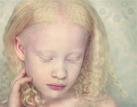 Unpigmented Photography Albino African Albinism Albino Girl