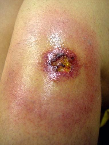 Brown Recluse Spider Bite Medical Pictures Info Health Definitions