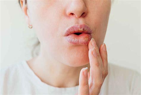 Lip Allergy Cause Symptoms Treatment And Prevention Of Lip Allergy