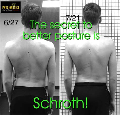 Treating Scoliosis Schroth Therapist Florida Physical Therapists