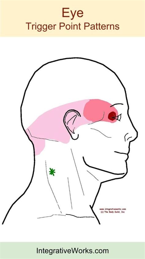 Trigger Points Neckche Headache Eyeache Integrative Works Migraine