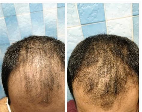 Aggregate 142 Rogaine Hair Regrowth Super Hot Vn