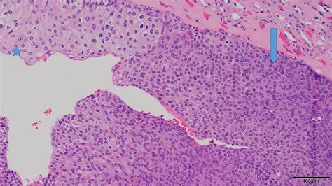 Educational Case Renal Cell And Urothelial Carcinoma Paige Carlson