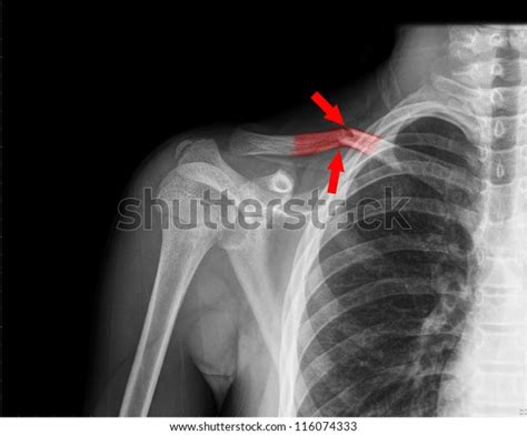 X Ray Collarbone Stock Photo 116074333 Shutterstock