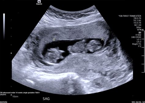 20 Weeks Pregnant With Twins Ultrasound