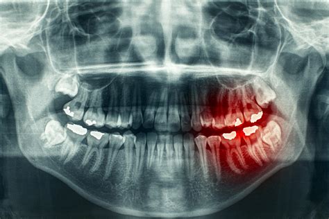 Oral Surgeons Share 3 Common Symptoms Of Jaw Cancer Oral Surgery